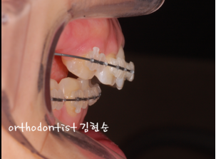 강남 돌출입 교정 관련 이미지 16