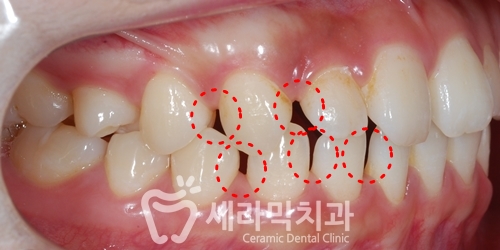 벌어진치아 세라믹교정 치아교정전후 세라믹치과 관련 이미지 2
