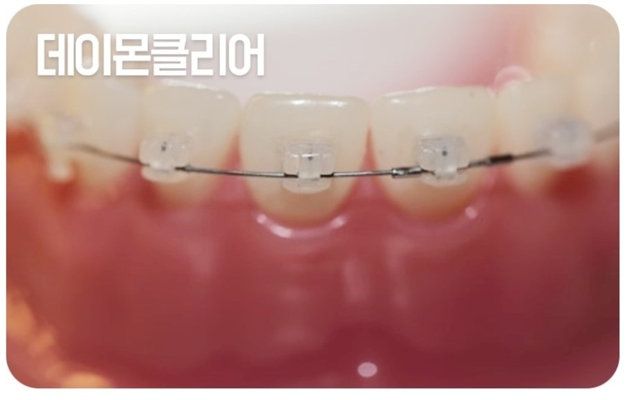 세라믹교정 클리피씨 데이몬 차이점 요약 관련 이미지 6