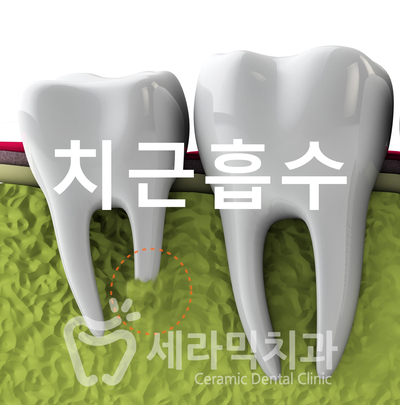 치아교정 부작용 제대로 알기 1. 관련 이미지 2