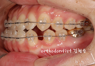 반대 교합 관련 이미지 17