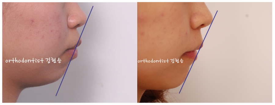 미니스크류, 돌출입 발치 교정 잇몸노출 개선 관련 이미지 13