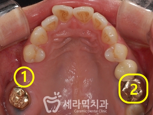상실된 치아가 있어도, 금니가 있어도 치아교정전후는 계속된다! 관련 이미지 3