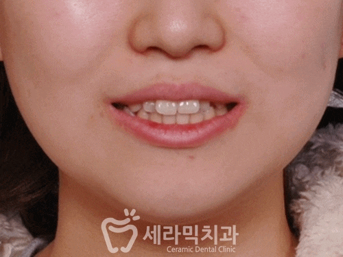 돌출입 치아교정전후. 몰라보게 달라진 얼굴변화 관련 이미지 1