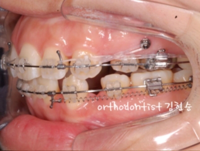 강남치아교정추천 관련 이미지 24