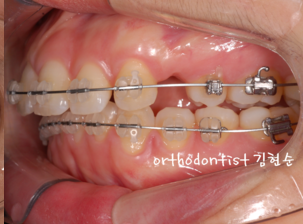 강남 돌출입 교정 관련 이미지 28