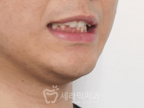 A Case of Overretained Teeth and Deep Bite Orthodontics That Helped the Patient Smile Confidently Before and After image 13