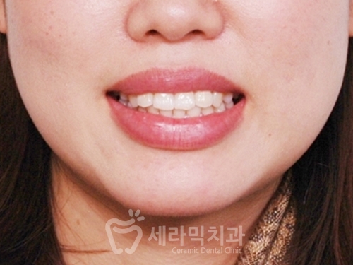 돌출입교정만 했을 뿐인데, 성형한 것처럼 달라진 인상! 관련 이미지 4