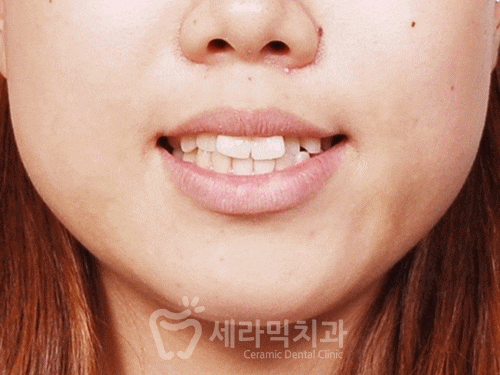 학동역 치아교정, 수술없이 예뻐져도 되나요? [돌출입교정 전후 달라진 외모] 관련 이미지 7