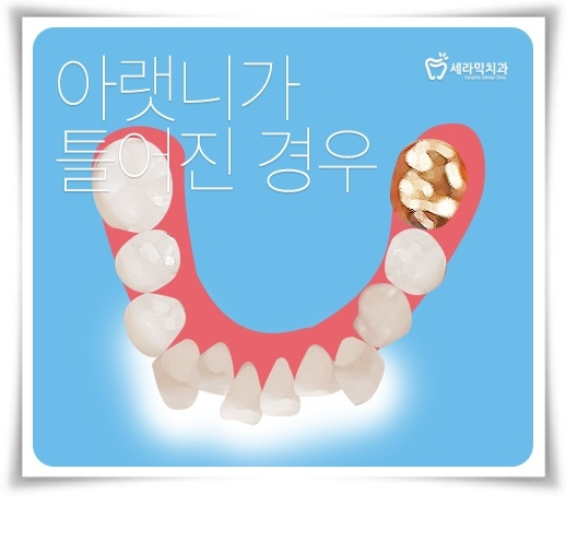 학동역치과 세라믹치과 앞니투명교정 관련 이미지 5