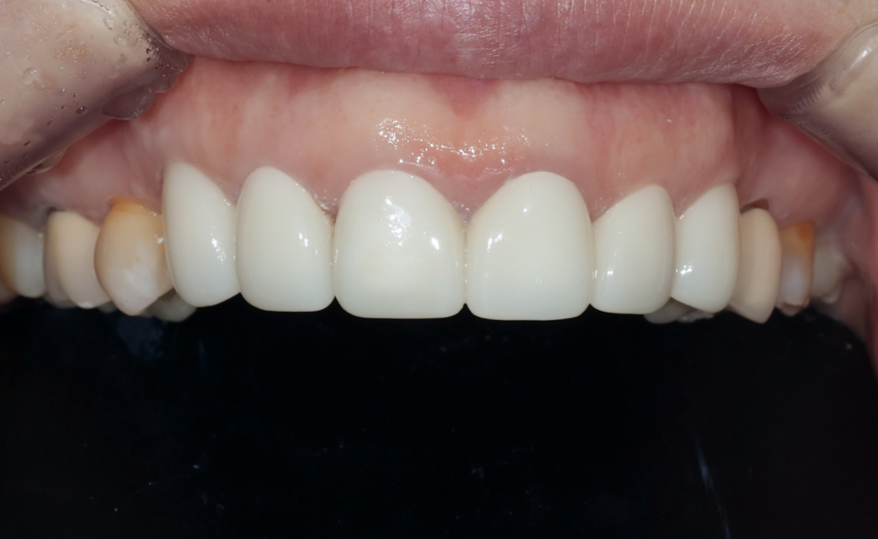 일본에서 거절당했던 앞니 심미보철 크라운 관련 이미지 11