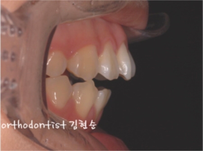 강남치아교정추천 관련 이미지 11