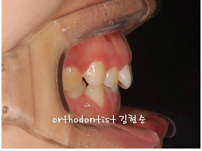 강남 과개 교합 관련 이미지 4