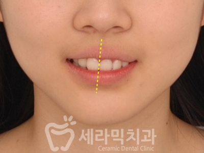 과개교합 치아교정잘하는곳, 세라믹치과 치아교정전후! 관련 이미지 8