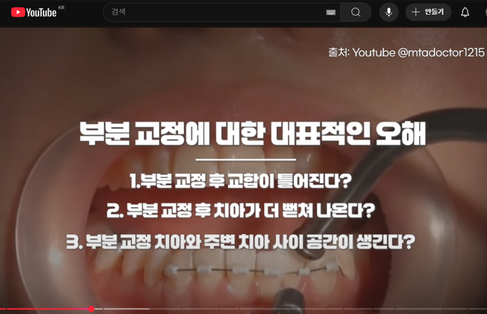 토끼이빨 앞니 부분교정, 실패하지 않는 방법은 관련 이미지 3