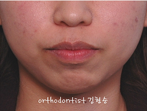 강남 돌출입 교정 관련 이미지 2