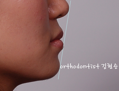 반대 교합 관련 이미지 12