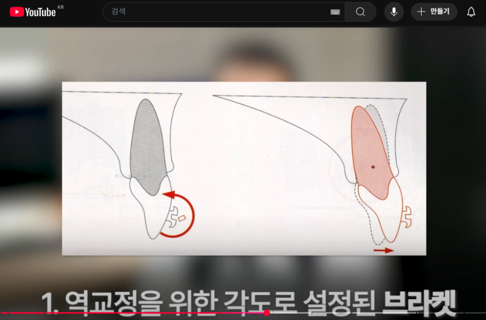 '옥니 역교정' 의미, 치료법, 부작용 알아보기 (+교정치과 선택 Tip) 관련 이미지 3