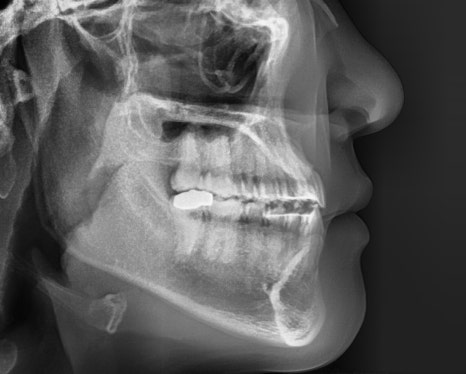 치아가 반대로 물리는 관련 이미지 7