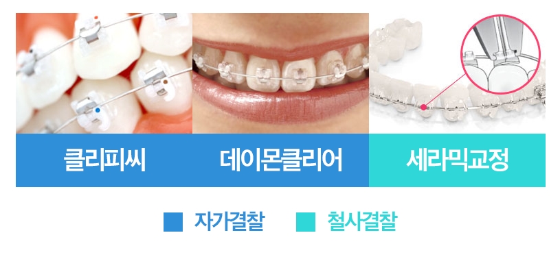 세라믹교정, 모르겠다면 이곳을 클릭 관련 이미지 7
