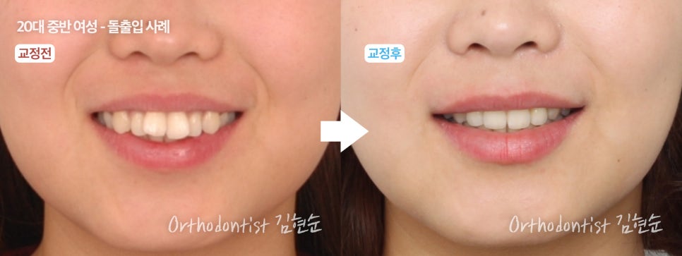 학동역치과 치아교정은 여기서 !! 관련 이미지 20