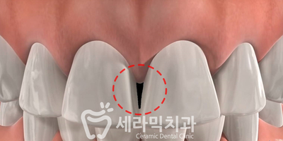 치아교정 부작용 3. 치아 사이 틈(블랙트라이앵글) 관련 이미지 4