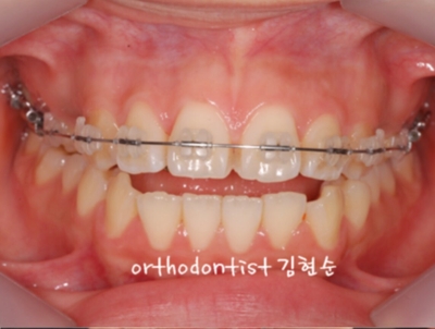 강남치아교정추천 관련 이미지 12