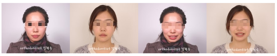 발치 돌출입교정으로 인상개선, 동안 만들기 관련 이미지 11