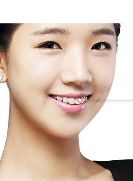 세라믹교정 3M  치아교정 모델 신청 ~ 관련 이미지 5