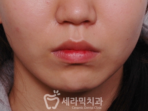 치아교정전후 : 돌출입과 치열불규칙을 발치교정으로 개선! 관련 이미지 1