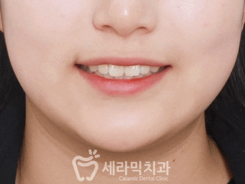 돌출입 앞니부분교정 치아교정전후 더 환해진 미소! 관련 이미지 3