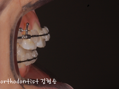 돌출 교정 (비발치 교정/비대칭) 관련 이미지 21