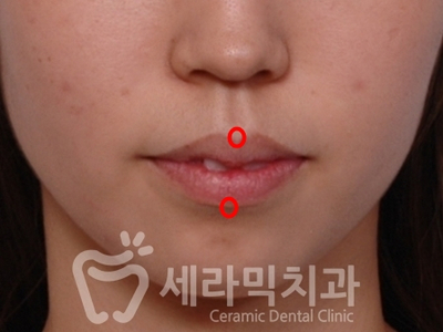 치아교정 전후 확연한 인상 변화! 관련 이미지 3