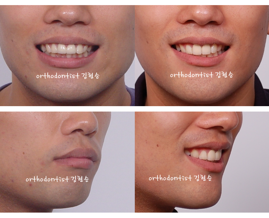 세라믹교정 세라믹치과-돌출입발치교정 1 관련 이미지 9