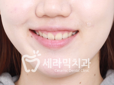 돌출입 치아교정 사례(학동역 치아교정 세라믹치과) 관련 이미지 5
