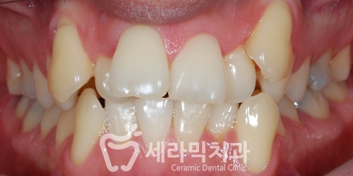 치열불규칙 치아교정으로 활짝 웃게 된 치아교정전후 관련 이미지 1