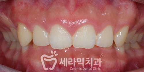 딥바이트 과개교합 치아교정전후 활짝 웃게 된 사례 관련 이미지 2