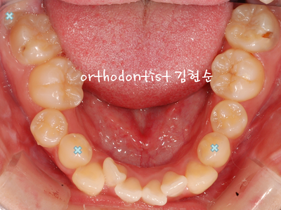 치열 교정(치열 불규칙) 관련 이미지 17