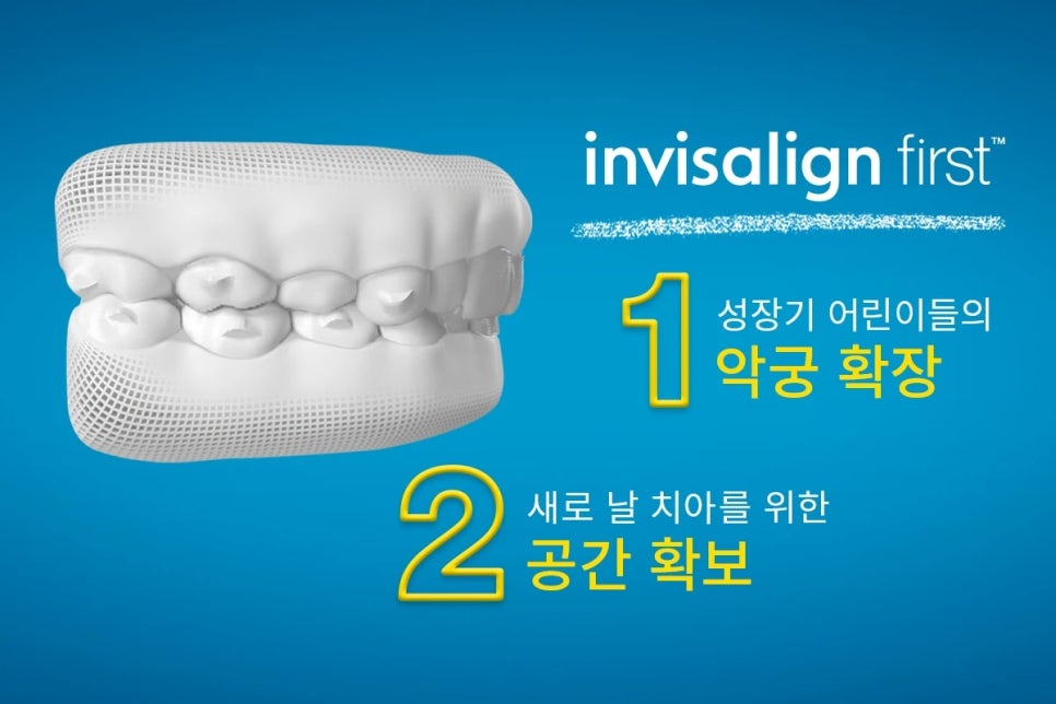 투명교정 대표주자 관련 이미지 7