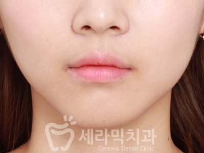 과개교합 치아교정잘하는곳, 세라믹치과 치아교정전후! 관련 이미지 20