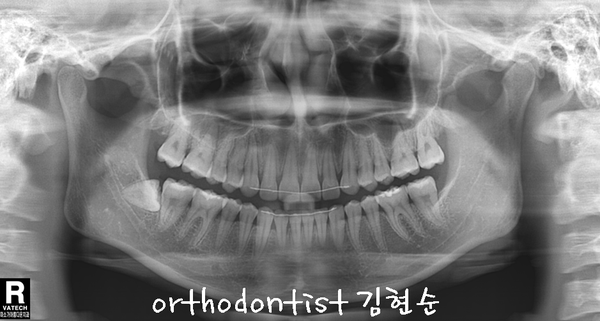 돌출 교정 (비발치 교정/비대칭) 관련 이미지 34