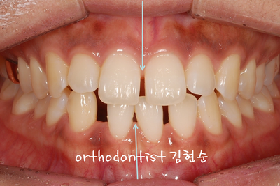 치열 교정 ( 벌어짐 ) 관련 이미지 5