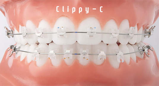 클리피씨교정 기간 짧을까? 관련 이미지 5