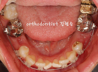 강남 돌출입 교정 관련 이미지 16