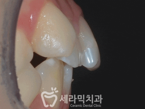 치열불규칙과 돌출입 치아교정전후 턱라인 변화! 관련 이미지 3