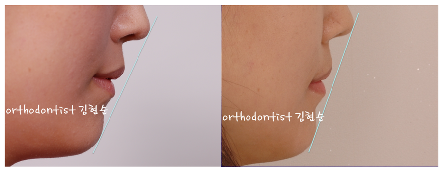 개방교합 비발치 세라믹교정 관련 이미지 14