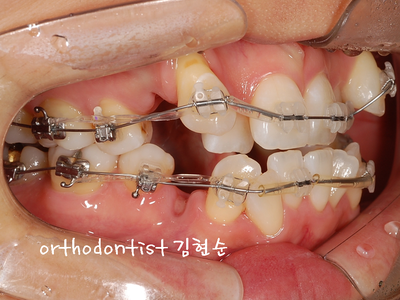 강남 덧니 관련 이미지 16