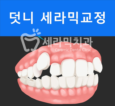 덧니 세라믹교정 전후사진, 학동역 세라믹치과 관련 이미지 1