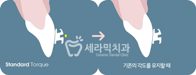 토끼이빨 돌출입 치아교정 전후 표정변화! 관련 이미지 11