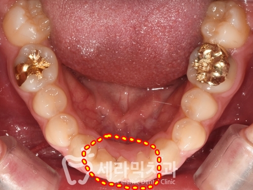 과개교합과 돌출입 개선으로 달라진 인상, 세라믹치과 치아교정전후! 관련 이미지 7